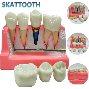 Новый Зубной имплантат, обучающая коронка, Мостовидный протез, Съемная модель Фарфоровых зубов, Демонстрационная модель зубов для обучения стоматологов